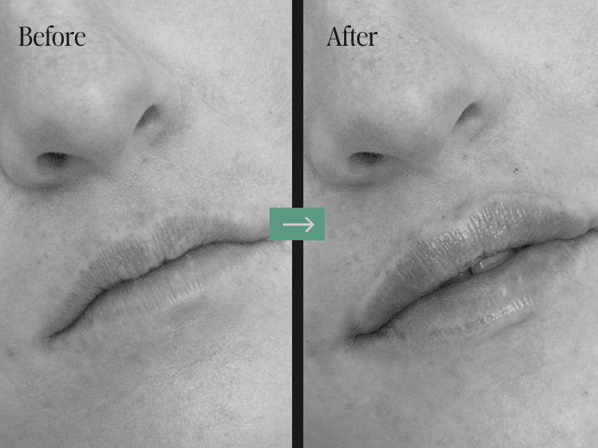 Laser Treatments Before and After Pictures Charleston County, SC